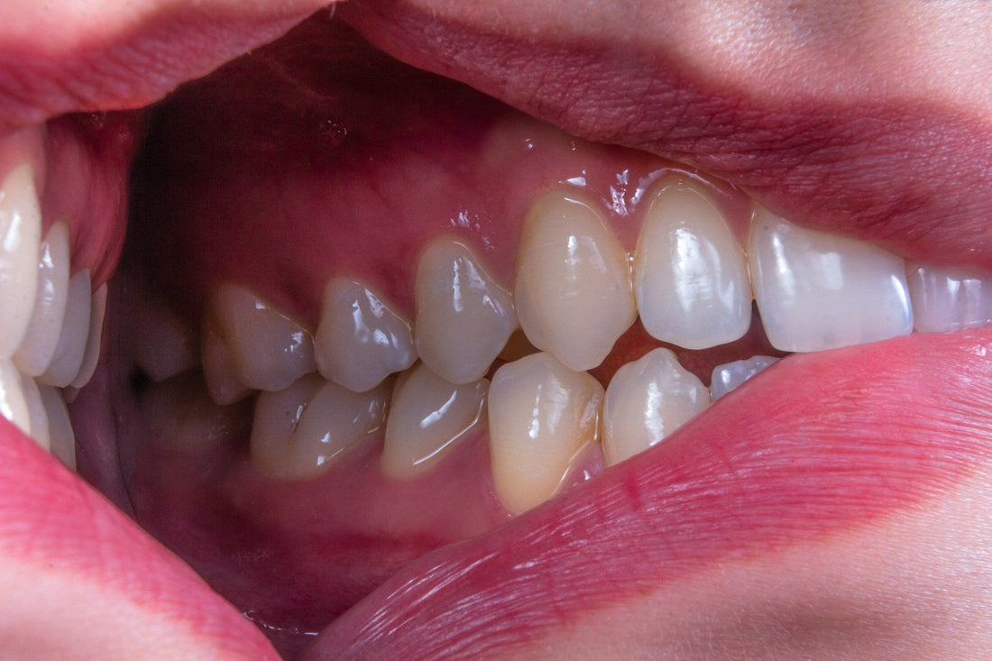 Can U Reverse Tooth Decay? What to Do Before a Cavity Forms