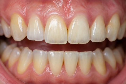 Enamel Thinning Front Teeth: Protect What Remains